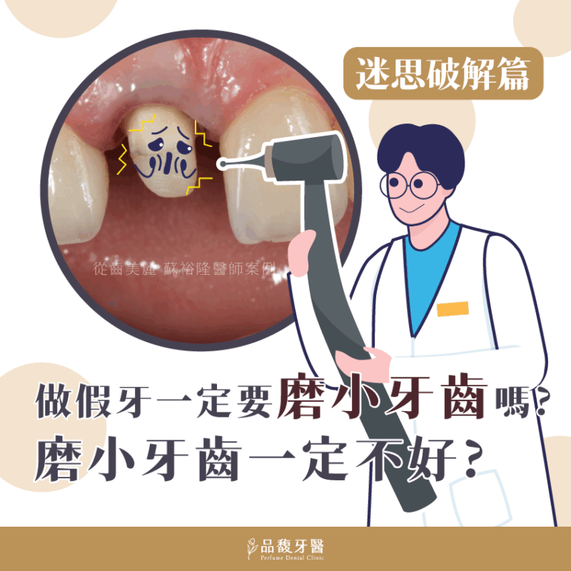 做假牙前一定要把牙齒磨小？關於磨牙的五大常見誤解／蘇裕隆醫師【品馥牙醫】