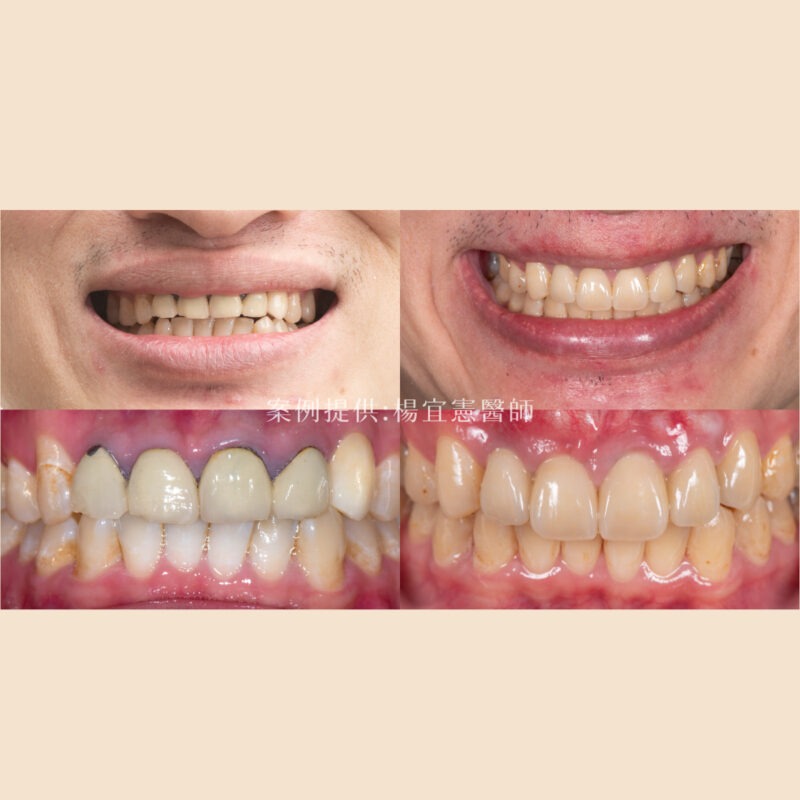 【品馥牙醫】案例013＿前牙美學重建案例 軟組織移植/微創植牙／楊宜憲醫師