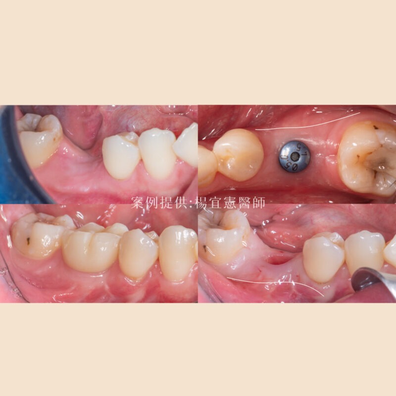 【品馥牙醫】案例014＿皮瓣移植手術找回牙齦成功植牙／楊宜憲醫師